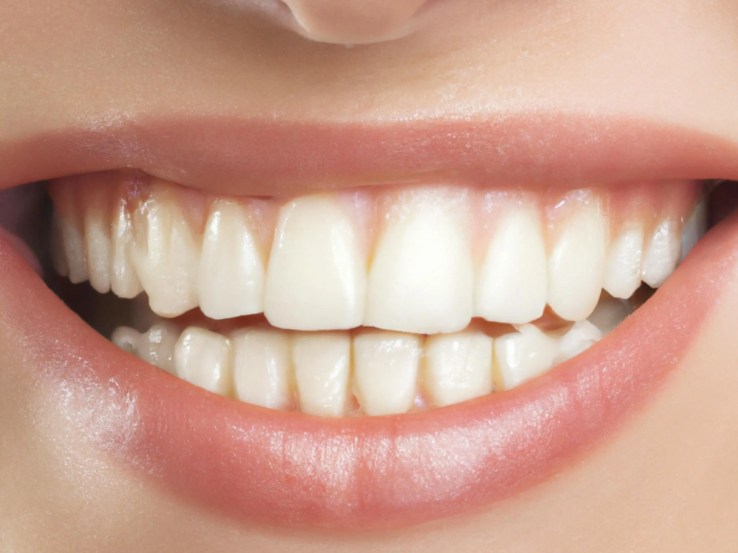 Correction du Sourire Gingival