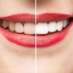 protheses-facettes-dentaires-1