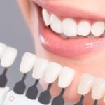 protheses-facettes-dentaires-2