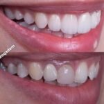 protheses-facettes-dentaires-7