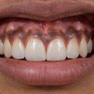 Dépigmentation des gencives.