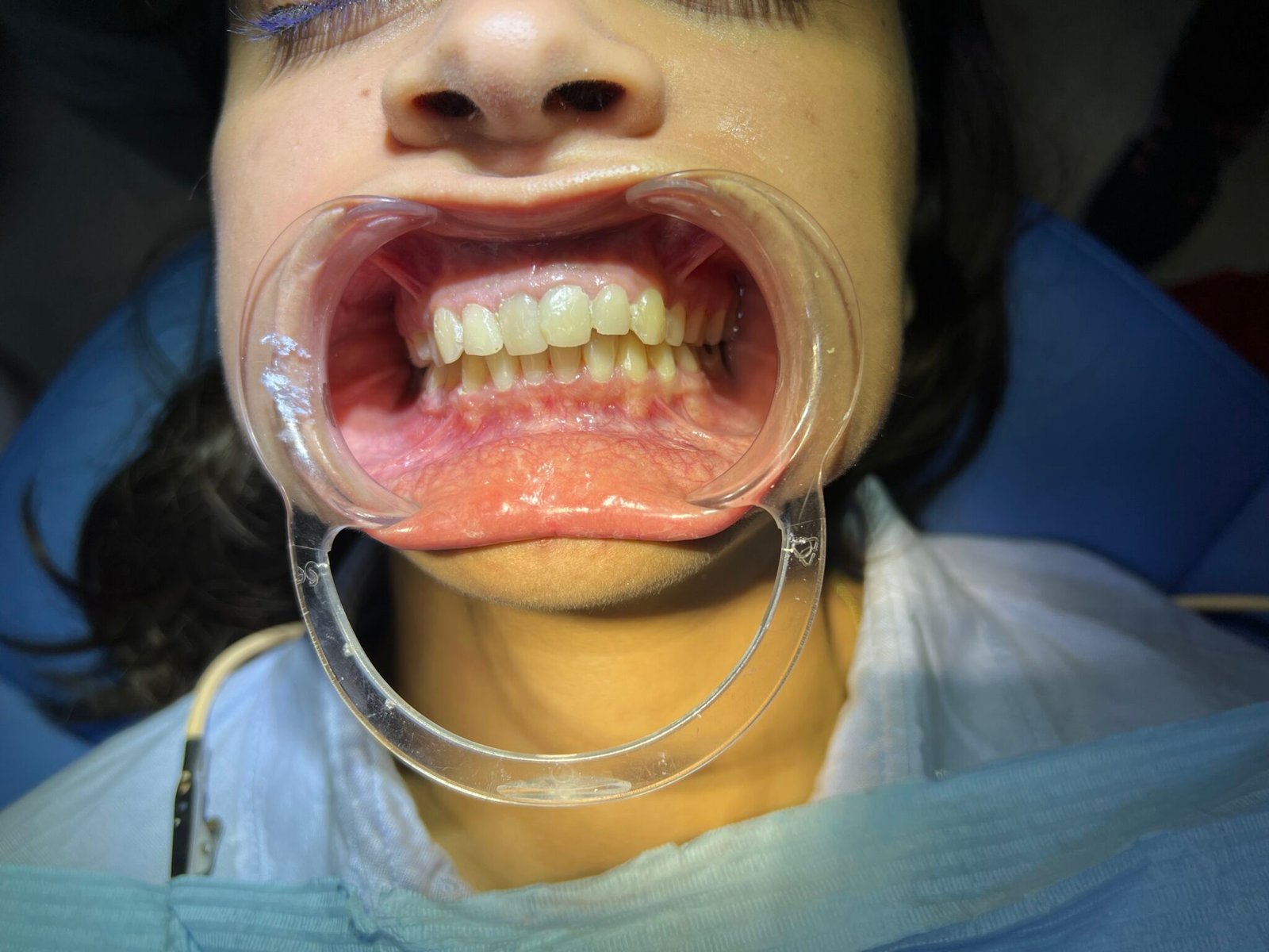 Avant traitement, patient 3