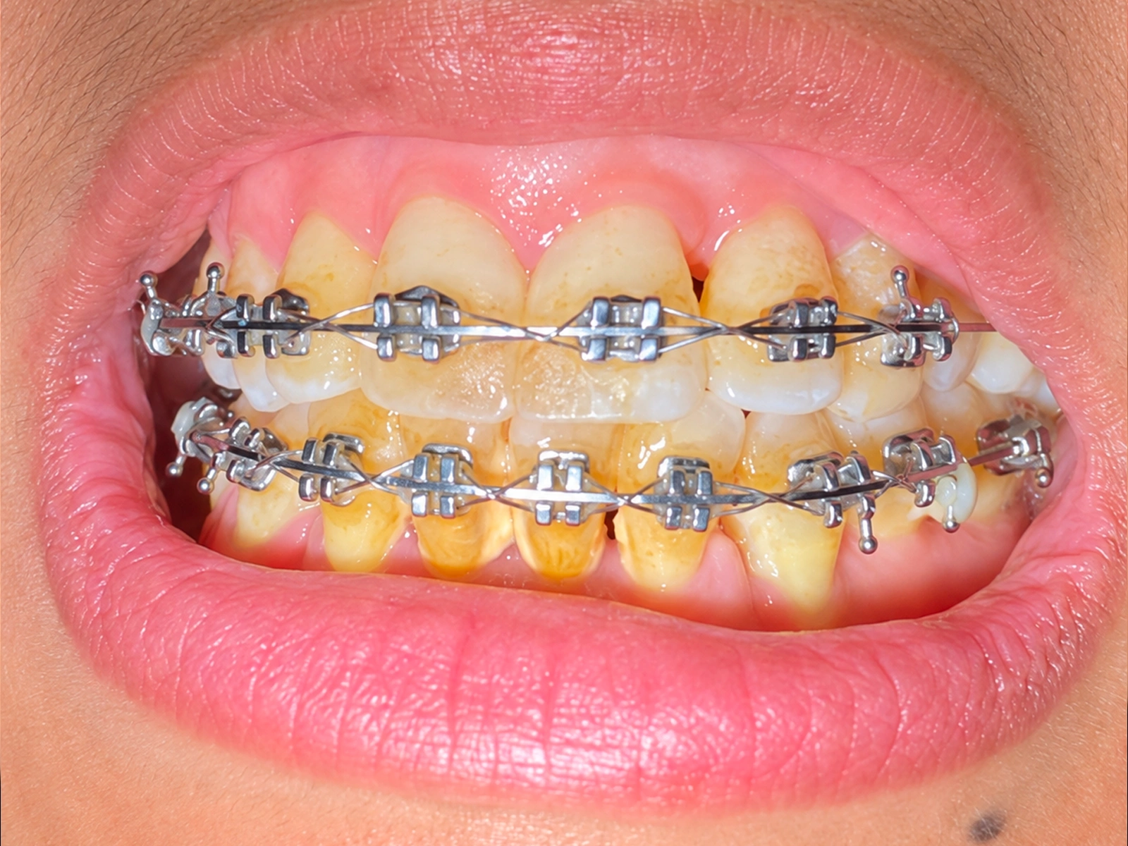 Avant traitement, patient 5